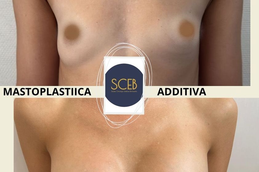Mastoplastica additiva prima e dopo - 880607