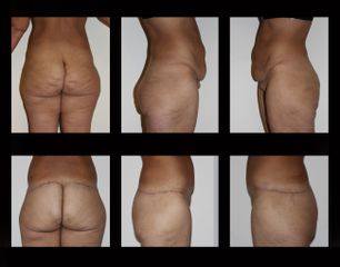 lift glutei prima e dopo