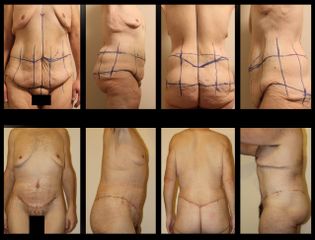 Belt lipectomy prima e dopo