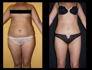 liposcultura total body prima e dopo