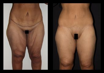 Lifting cosce prima e dopo