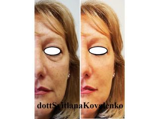 Peeling e contorno occhi - Dott.ssa Kovalenko Svitlana
