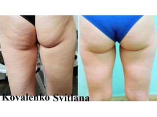 Cellulite prima e dopo