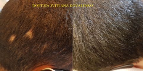 Alopecia areata trattata con mesoterapia tricologica - Dott.ssa Kovalenko Svitlana