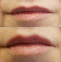 Ringiovanimento labbra con filler acido ialuronico - Dott.ssa Kovalenko Svitlana