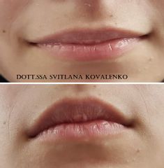 Trattamento labbra con filler acido ialuronico - Dott.ssa Kovalenko Svitlana