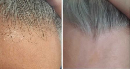 Trapianto capelli - Dott.ssa Kovalenko Svitlana