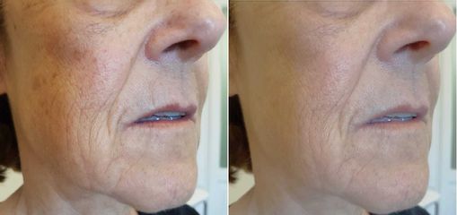 Dott.ssa Kovalenko Svitlana Skinbooster