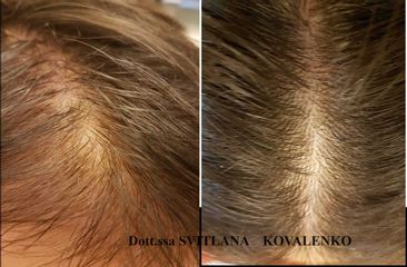 Alopecia - Dott.ssa Kovalenko Svitlana