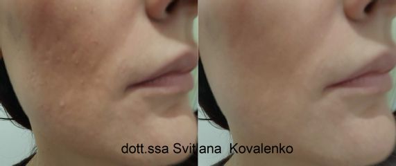 Trattamento peeling + biorivitalizzazione - Dott.ssa Kovalenko Svitlana