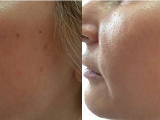 Peeling chimico prima e dopo - 868514