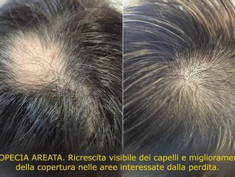 Alopecia prima e dopo - 880108