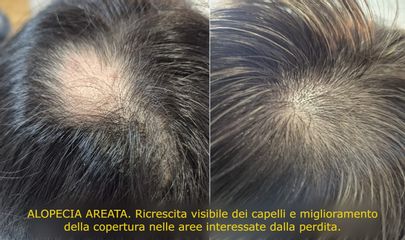 Dssa Kovalenko Alopecia