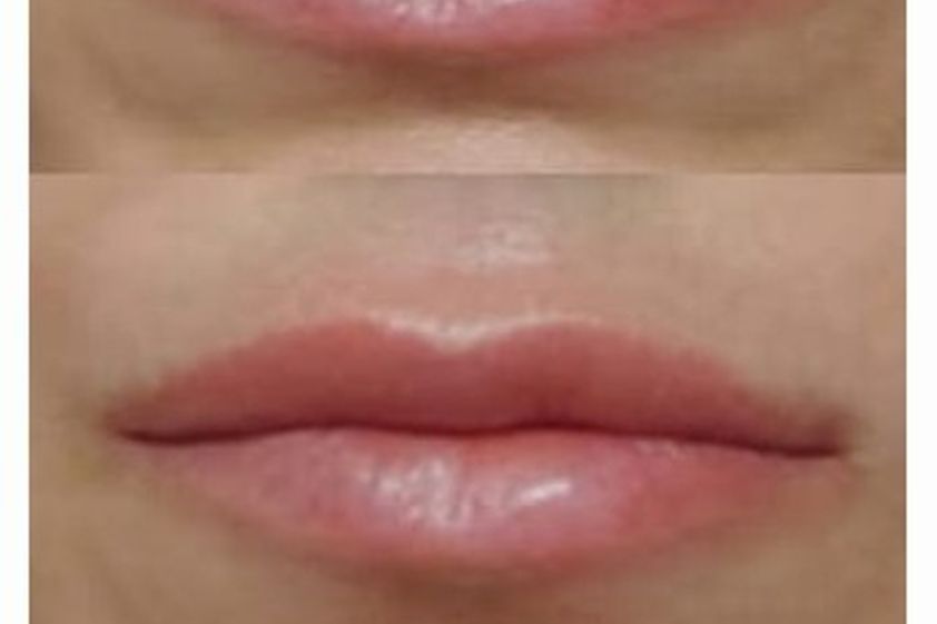Filler labbra prima e dopo - 880109