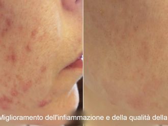 Acne prima e dopo - 880110