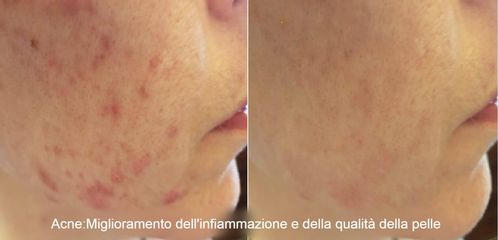 Dott.ssa Kovalenko Svitlana Acne