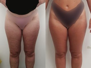 Mesoterapia - Dott.ssa Mariafranca Maietta