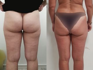 Mesoterapia - Dott.ssa Mariafranca Maietta