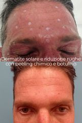 Dermatite solare e riduzione rughe con peeling chimico e botulino