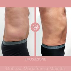 Liposuzione - Dott.ssa Mariafranca Maietta