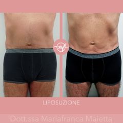 Liposuzione - Dott.ssa Mariafranca Maietta