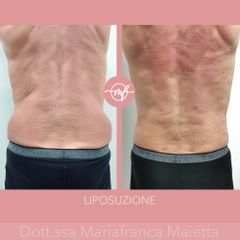 Liposuzione - Dott.ssa Mariafranca Maietta