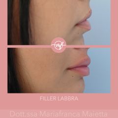 Filler labbra - Dott.ssa Mariafranca Maietta