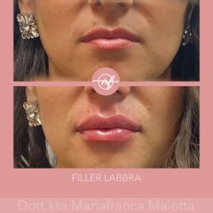 Filler labbra - Dott.ssa Mariafranca Maietta