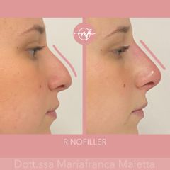 Rinofiller - Dott.ssa Mariafranca Maietta
