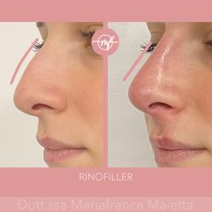 Rinofiller - Dott.ssa Mariafranca Maietta