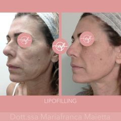Lipofilling - Dott.ssa Mariafranca Maietta