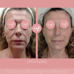 Lipofilling - Dott.ssa Mariafranca Maietta