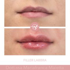 Filler labbra  - Dott.ssa Mariafranca Maietta