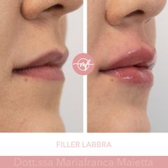 Filler labbra  - Dott.ssa Mariafranca Maietta