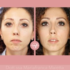 Botulino - Dott.ssa Mariafranca Maietta