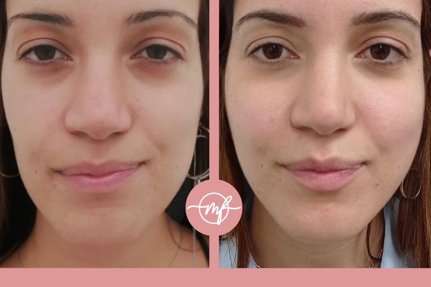 Mentoplastica prima e dopo - 830389