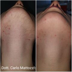 Depilazione Laser - Dott. Carlo Mattozzi