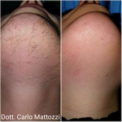 Depilazione Laser - Dott. Carlo Mattozzi