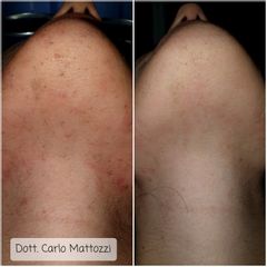 Depilazione Laser - Dott. Carlo Mattozzi