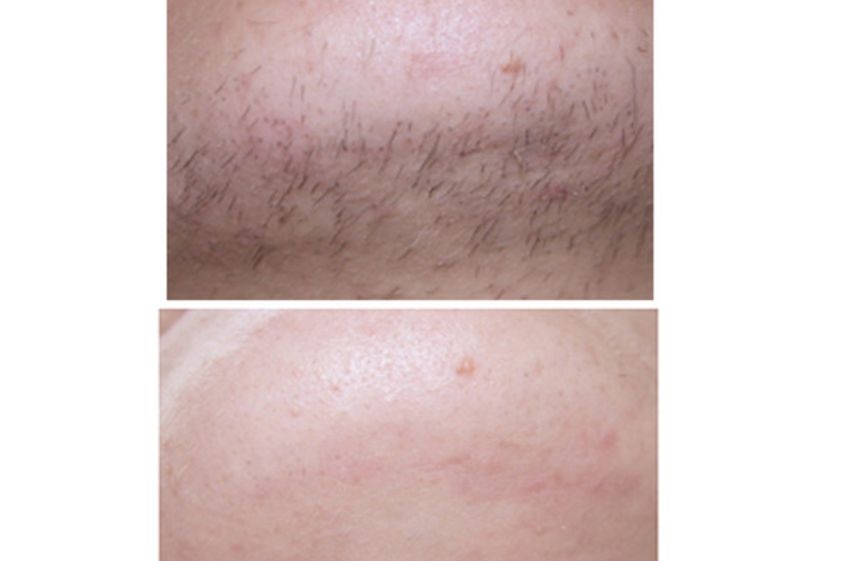 Depilazione laser prima e dopo - 751687