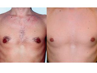 Epilazione laser prima dopo