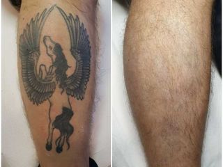 rimozione tatuaggio prima dopo