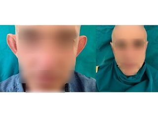 Otoplastica prima e dopo