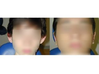 Otoplastica prima e dopo