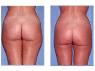 Liposuzione prima e dopo