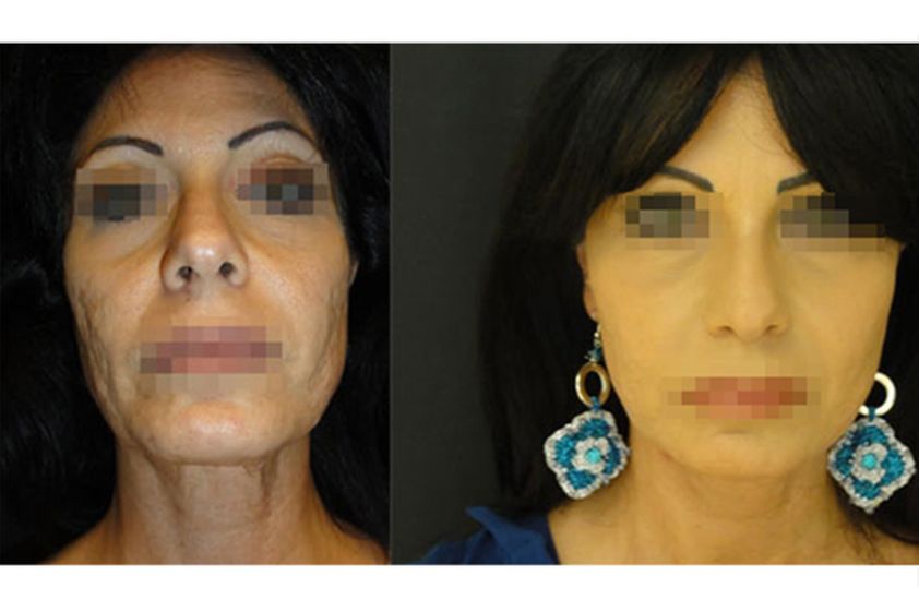 Acne prima e dopo - 751126