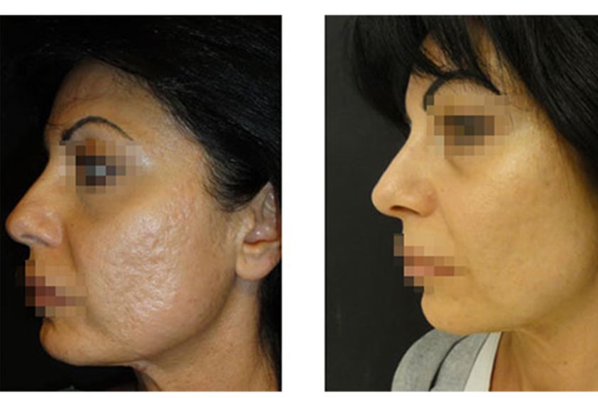 Acne prima e dopo - 751127