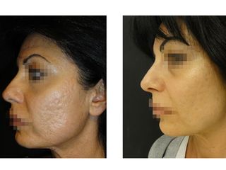 Trattamento cicatrici da acne