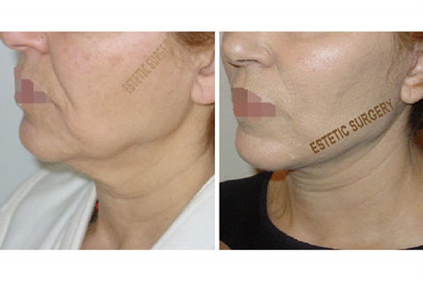 Lifting viso prima e dopo - 751130
