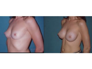 Mastoplastica additiva pre e post
